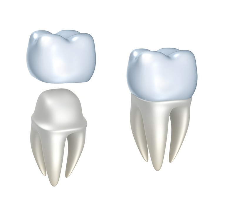 Dental Crowns Before and After | Chestermere Lifepath Dental | Lifepath Dental & Wellness