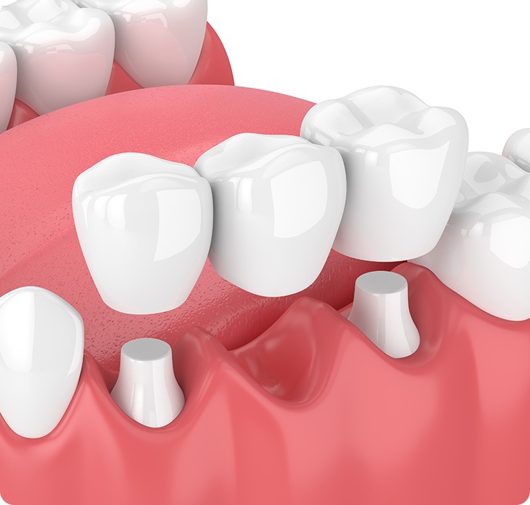 Dental Bridge Example | Chestermere Lifepath Dental | Lifepath Dental & Wellness