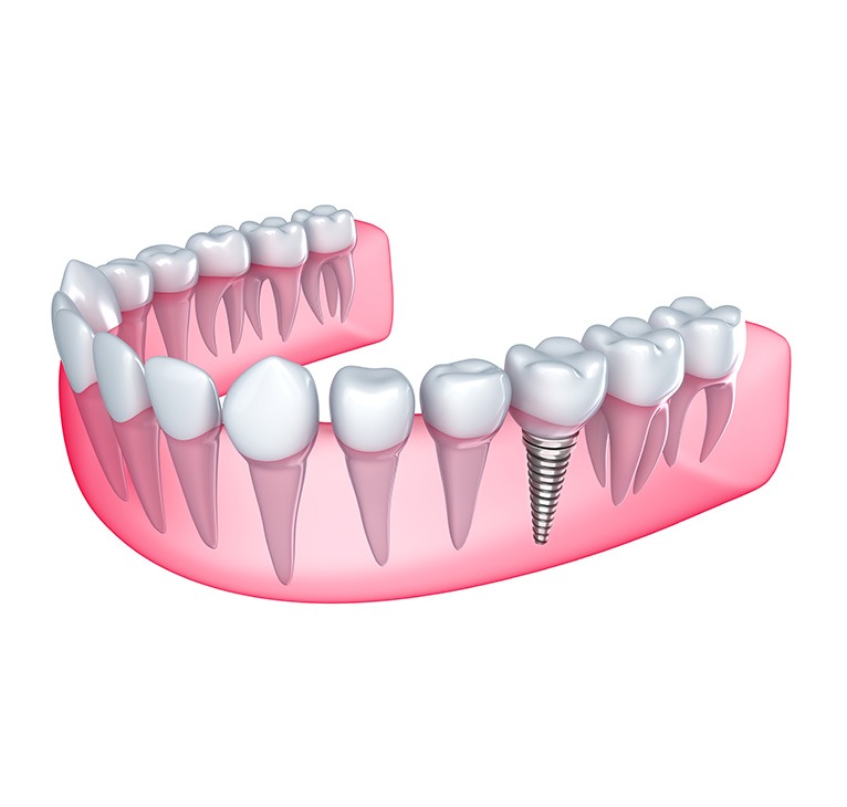Single Dental Implant Example | Chestermere Lifepath Dental | Lifepath Dental & Wellness