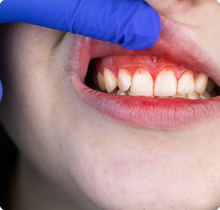 Gingivitis Symptoms | Chestermere Lifepath Dental | Lifepath Dental & Wellness