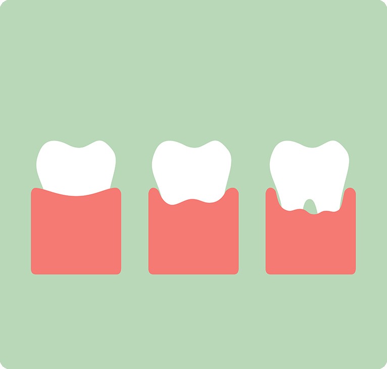 Gingivitis Progression Graphic Exam | Chestermere Lifepath Dental | Lifepath Dental & Wellness