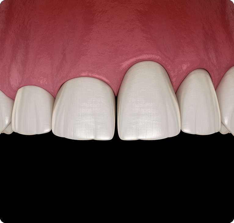 Gum Recession Treatment | Chestermere Lifepath Dental | Lifepath Dental & Wellness