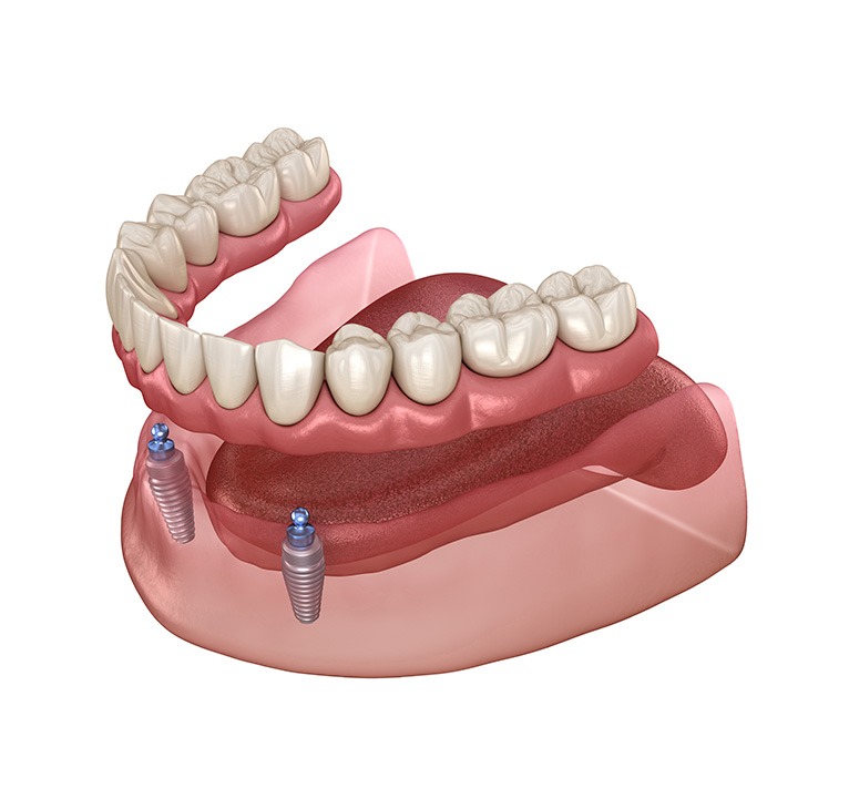 Implant Dentures | Chestermere Lifepath Dental | Lifepath Dental & Wellness