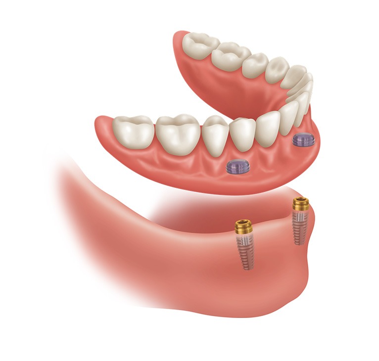 Implant Supported Dentures | Chestermere Lifepath Dental | Lifepath Dental & Wellness