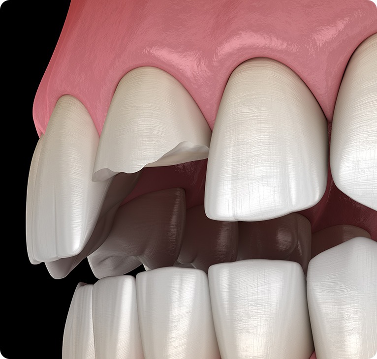 Broken Tooth Needing Oral Surgery | Chestermere Lifepath Dental | Lifepath Dental & Wellness