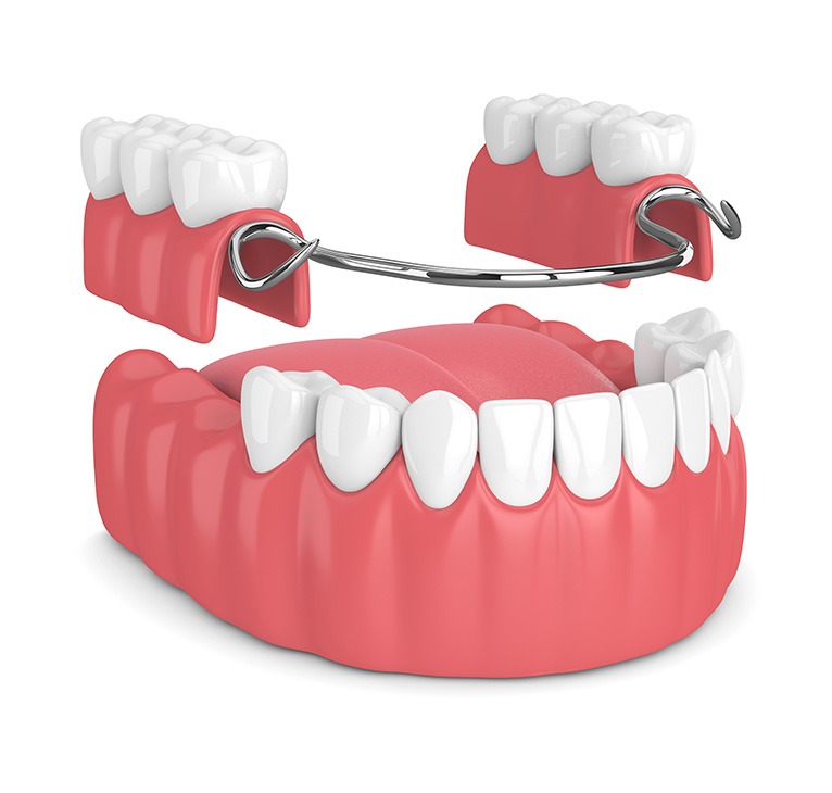 Partial Dentures | Chestermere Lifepath Dental | Lifepath Dental & Wellness