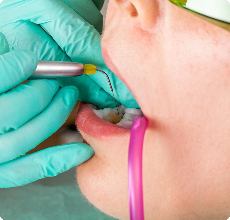Periodontitis Treatment | Chestermere Lifepath Dental | Lifepath Dental & Wellness