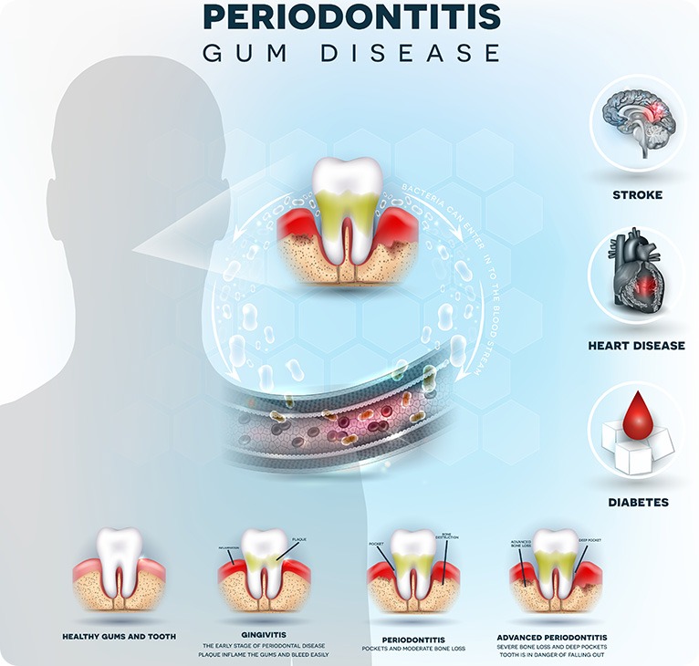 Periodontitis Gum Disease Chart | Chestermere Lifepath Dental | Lifepath Dental & Wellness