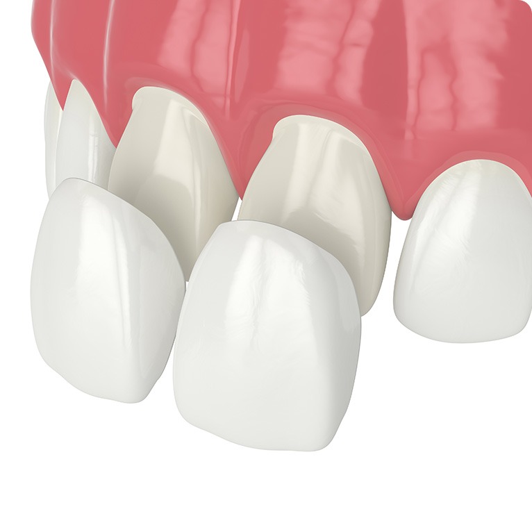 Porcelain Veneers Example | Chestermere Lifepath Dental | Lifepath Dental & Wellness