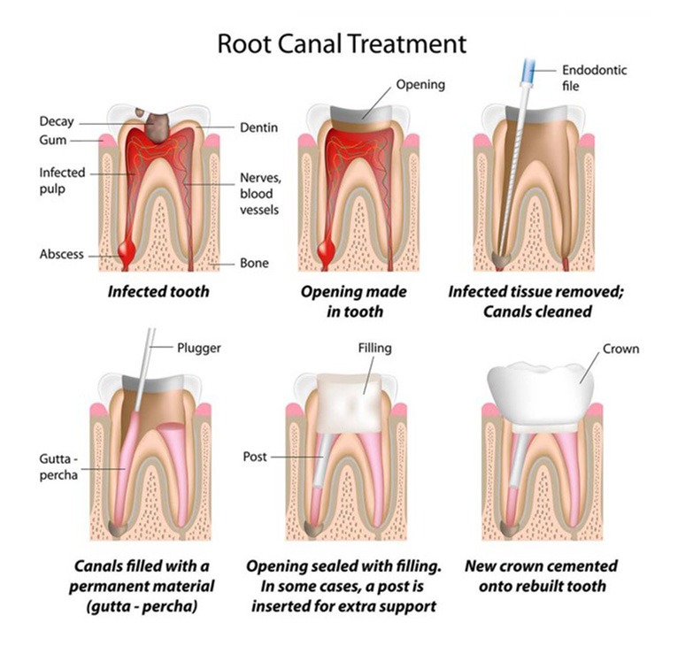 Root Canal Treatment Process | Chestermere Lifepath Dental | Lifepath Dental & Wellness