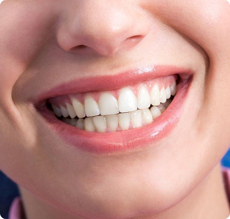 Patient Smile After Veneers | Chestermere Lifepath Dental | Lifepath Dental & Wellness