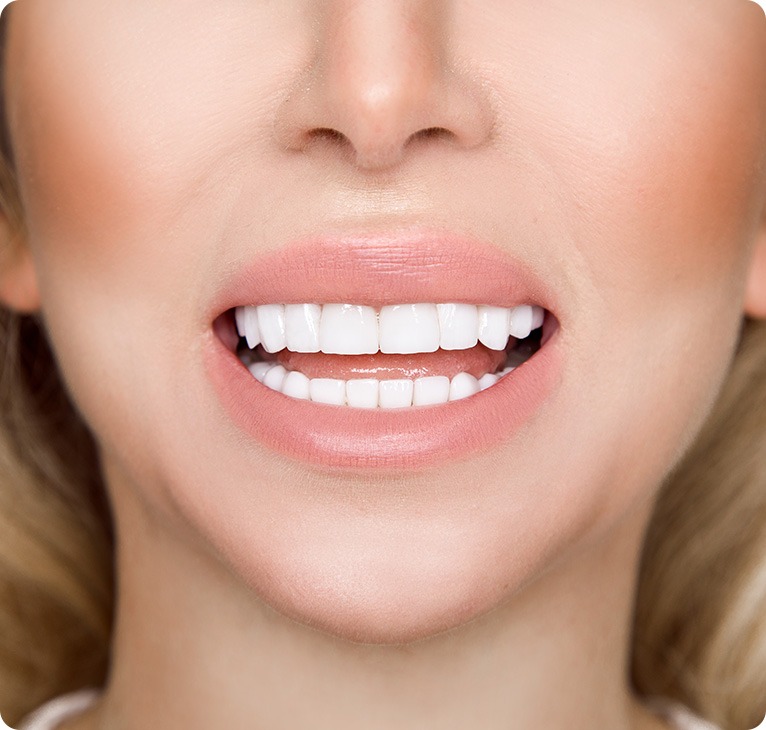 Veneers Example | Chestermere Lifepath Dental | Lifepath Dental & Wellness