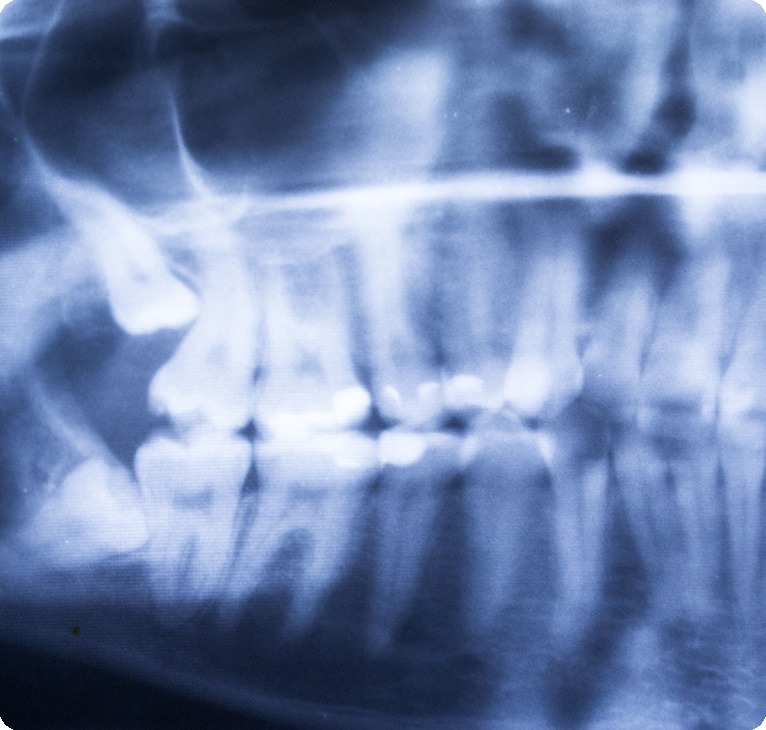 Wisdom Teeth Exams | Chestermere Lifepath Dental | Lifepath Dental & Wellness