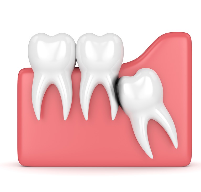 Wisdom Teeth Removal | Chestermere Lifepath Dental | Lifepath Dental & Wellness
